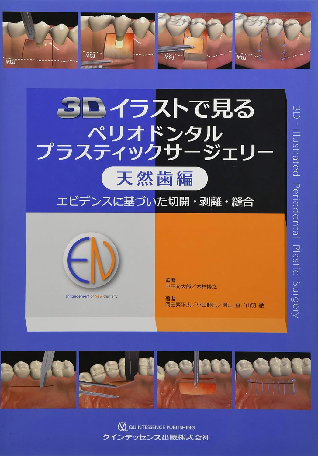 3Dイラストで見るペリオドンタルプラスティックサージェリー 天然歯編